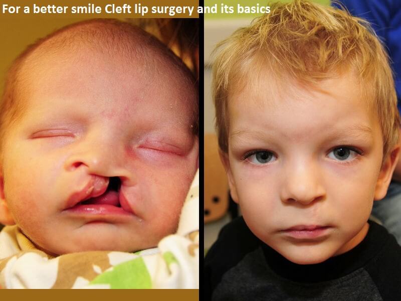 For a better smile: Cleft lip surgery and its basics