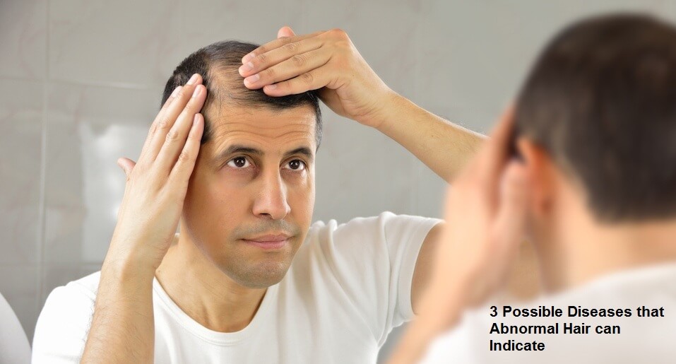 3 Possible Diseases that Abnormal Hair can Indicate