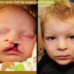 For a better smile: Cleft lip surgery and its basics