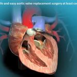 Safe and easy aortic valve replacement surgery at least cost