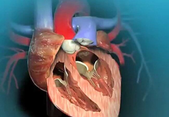 Safe and easy aortic valve replacement surgery at least cost