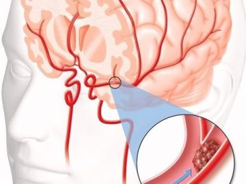 What is cerebral thrombosis