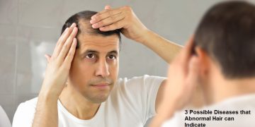 3 Possible Diseases that Abnormal Hair can Indicate