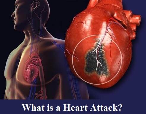 What is a Heart Attack?