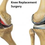 knee replacement surgery