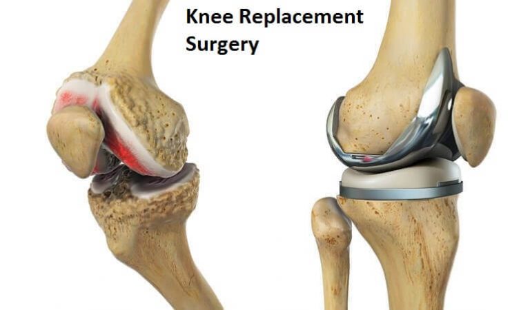 Step by step guide to availing knee replacement surgery