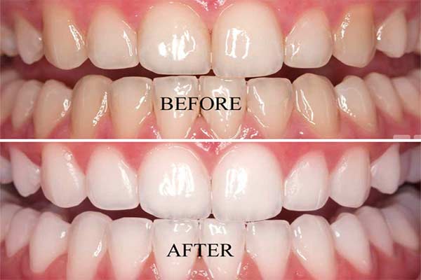 Wondering If Teeth Whitening Is Possible With Fillings? Read This